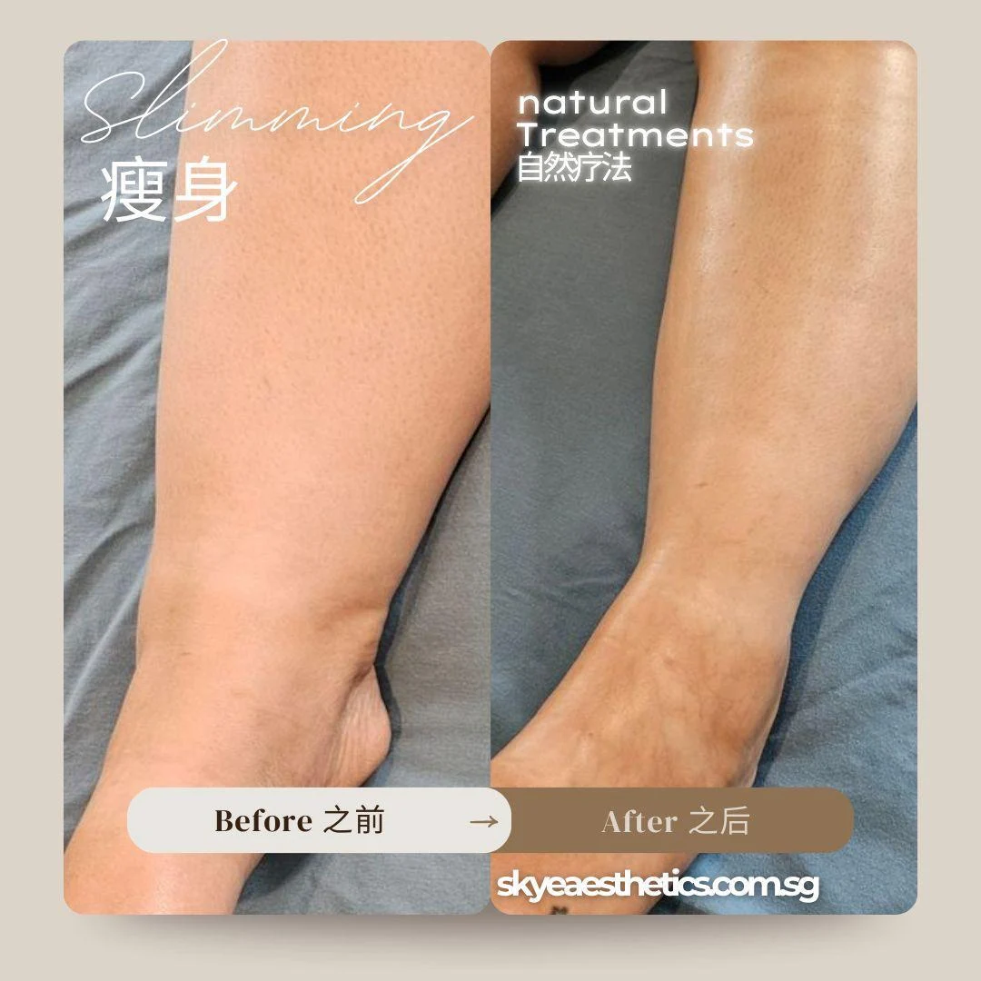 Leg contouring: original treatment comparison, with its original labels