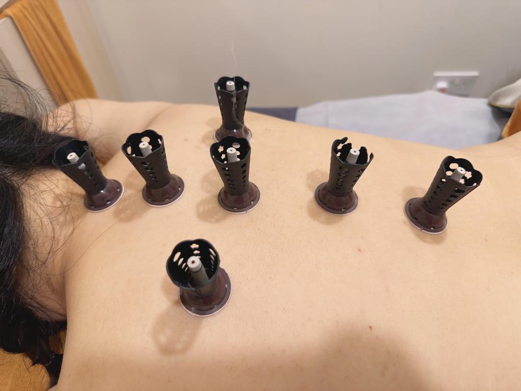 Moxibustion warming cones placed along the back before a Bojian body treatment